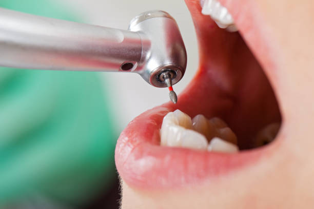 Best Emergency Root Canal Therapy in Cookeville, TN